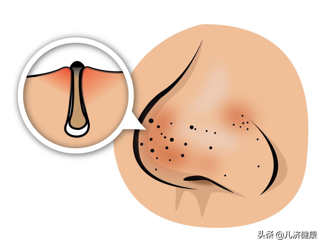 毛孔大黑头多怎么护肤,油性皮肤黑头毛孔粗用什么洗面奶