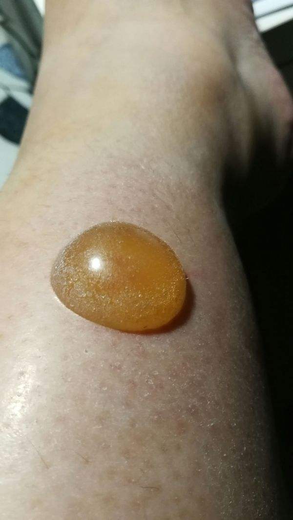 贴敷膏药的不良反应,贴敷疗法要关注什么