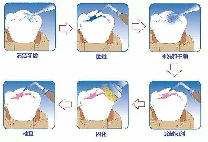 补个牙怎么要跑好几趟？太麻烦了吧，能一次搞定嘛！