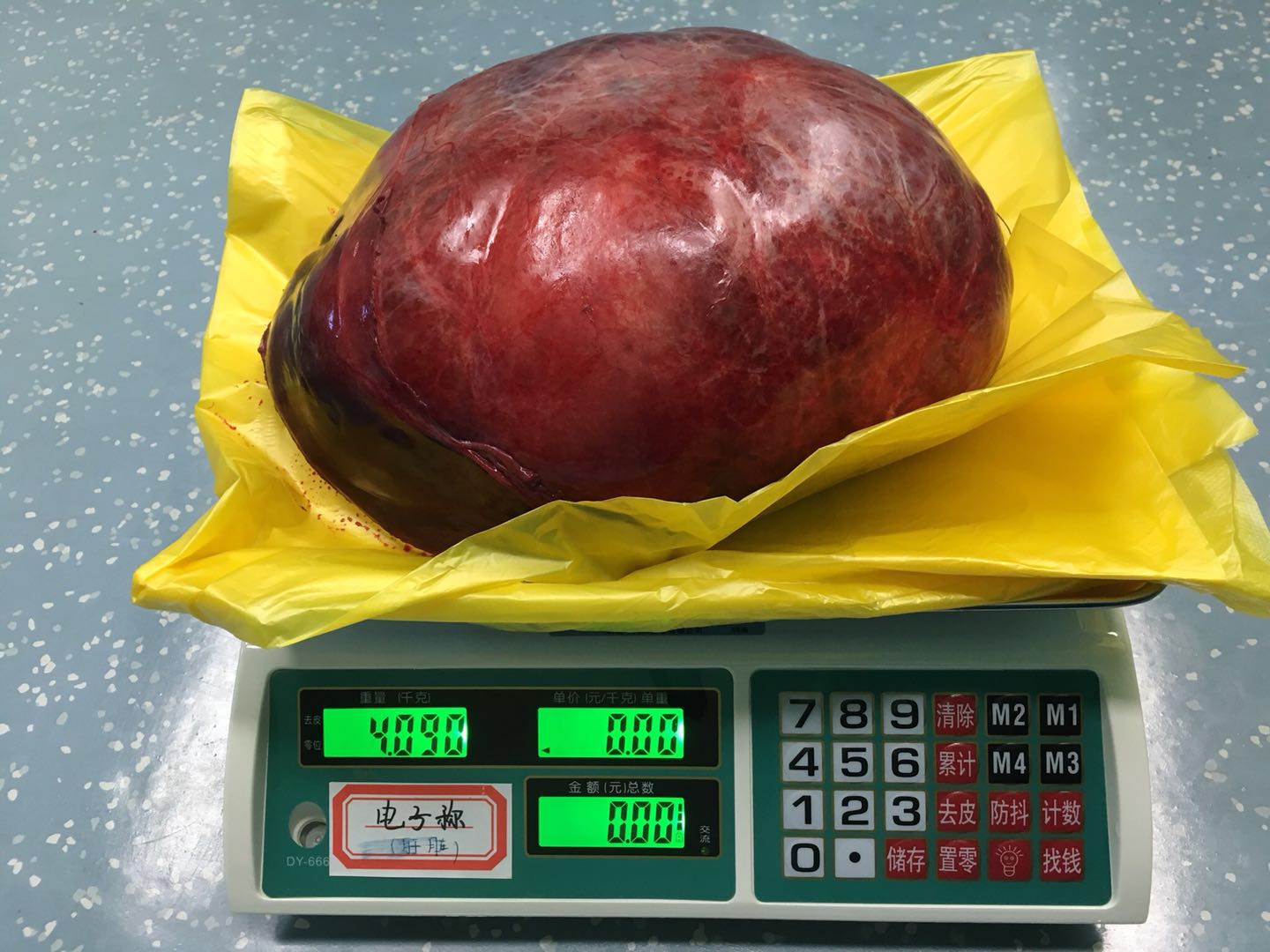 男子长10斤肿瘤专家6小时切除,肝上长肿瘤14cm能微创手术