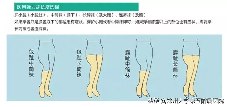 静脉曲张远离老烂腿,下肢静脉血管曲张怎么办
