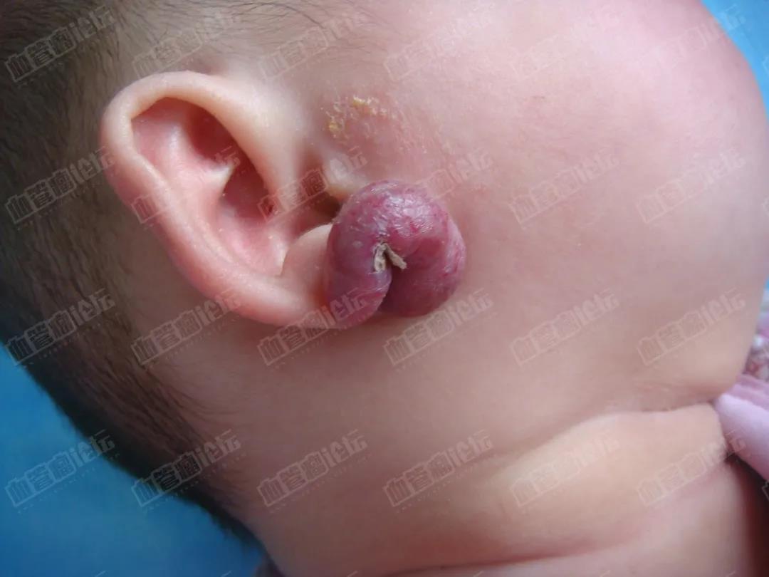 婴幼儿血管瘤的治疗「009期」董欣竞医生科普