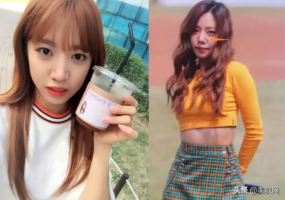 明星都在用的缩小鼻翼神器,明星鼻子做鼻翼缩小外切