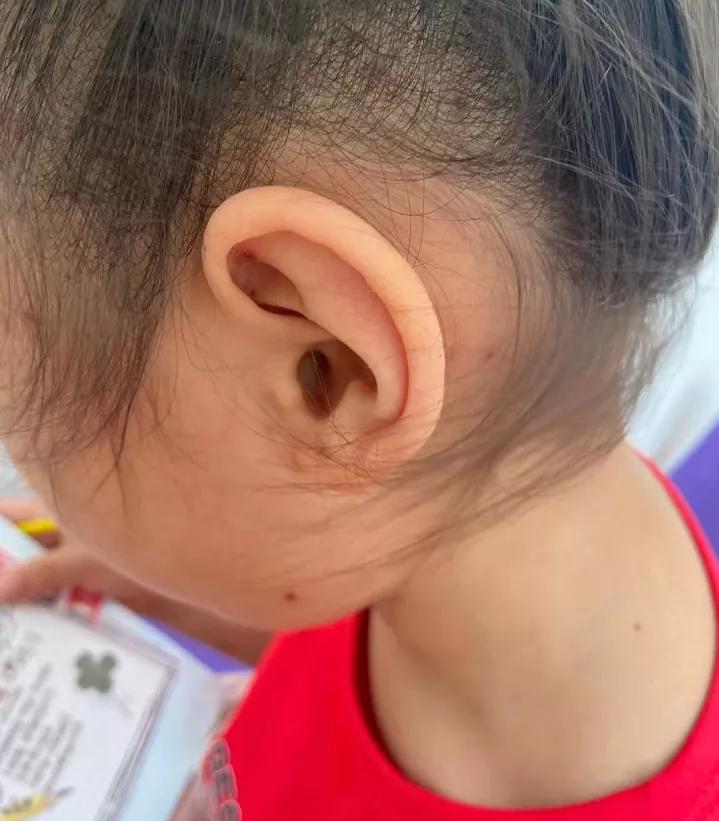 接触出水痘的孩子要再打疫苗吗,我家宝宝打疫苗后发烧