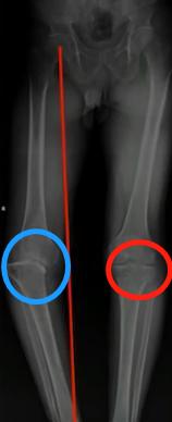 膝关节疼痛发热，当心痛风性关节炎，别乱吃药，医生教你缓解