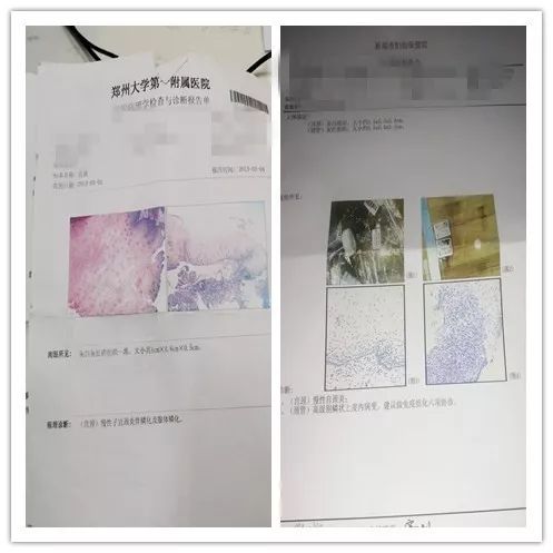 hpv疫苗预防宫颈癌的几率,预防宫颈癌打什么