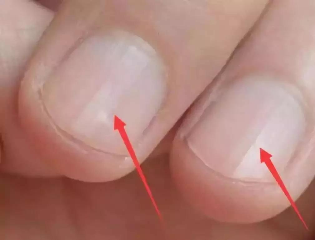 指甲半月牙少是怎么回事,指甲上月牙少是不是身体不好