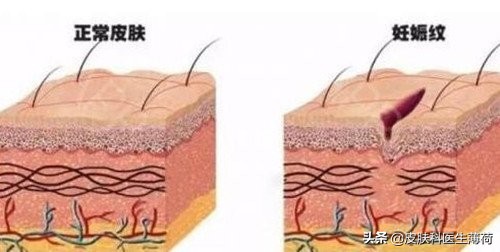 孕期长痘可以用的皮肤药,怀孕皮肤长斑长痘用什么护肤品