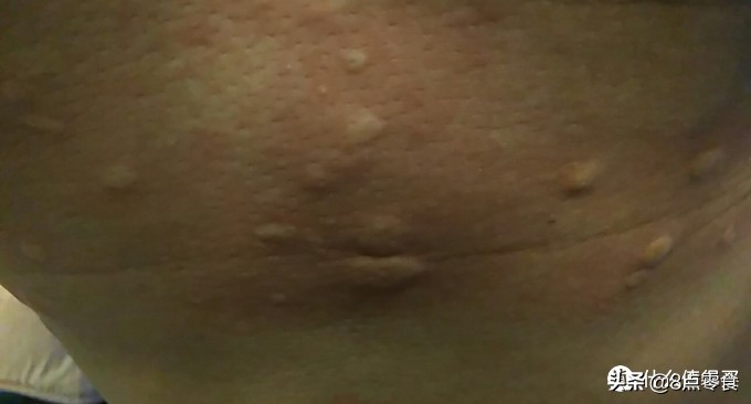 食蚕蛹过敏怎么处理,吃蚕蛹过敏反应是什么表现