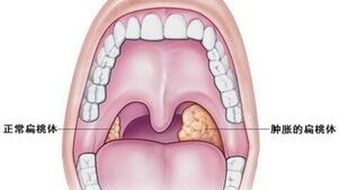 宝宝扁桃体发炎怎么预防最好,小孩扁桃体炎平时怎么预防