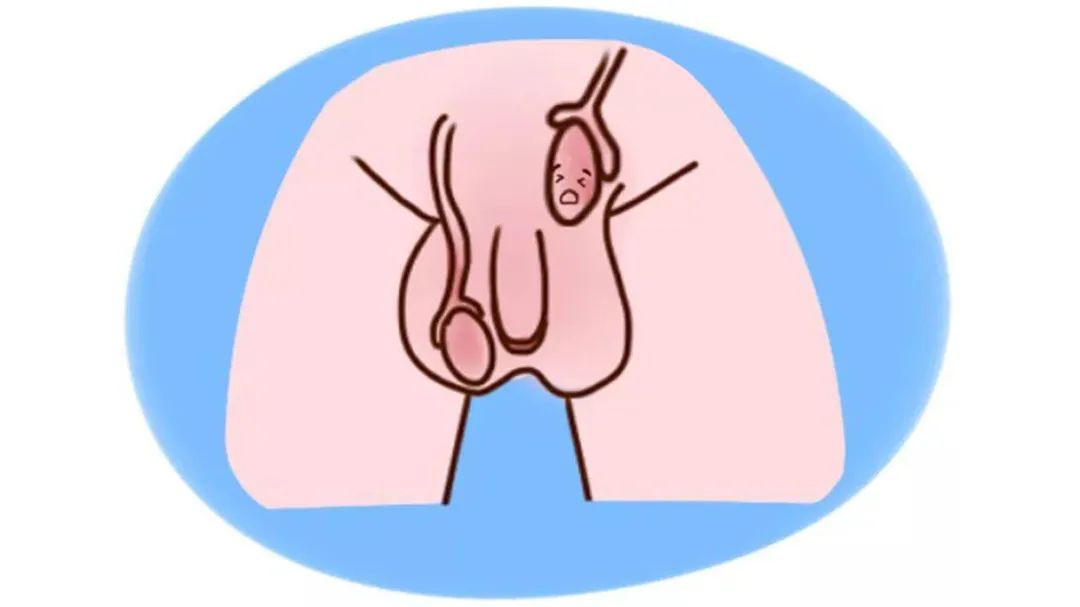 隐睾的宝宝如何日常护理,宝宝先天性隐睾怎么判断