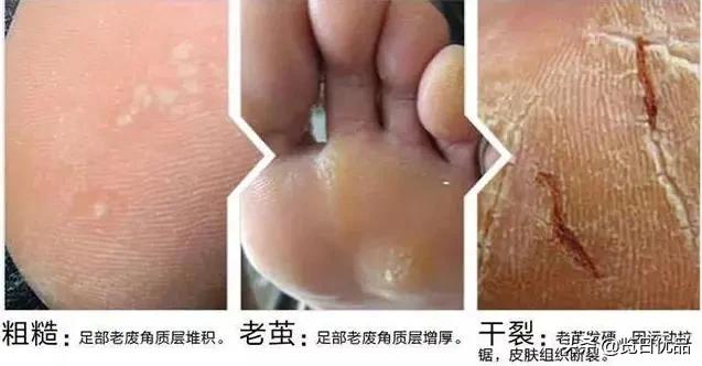 爽炸了！干丑裂的脚皮，一张完整撕掉，敢跟婴儿比姣嫩！