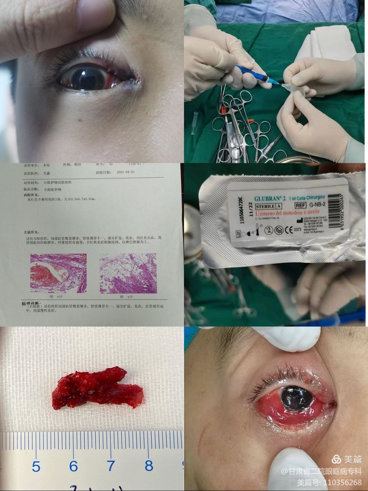 眼眶血管畸形介入治疗多少钱,眼眶血管畸形手术