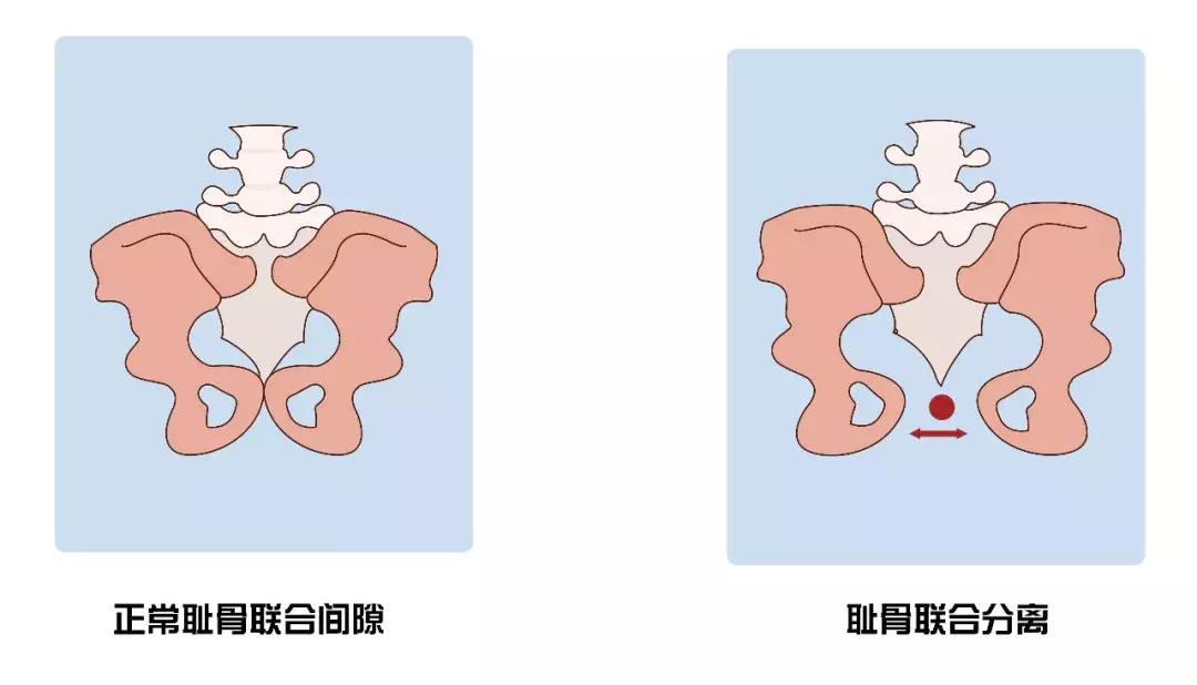 孕期耻骨疼，别不当回事儿，小心耻骨分离症缠上你