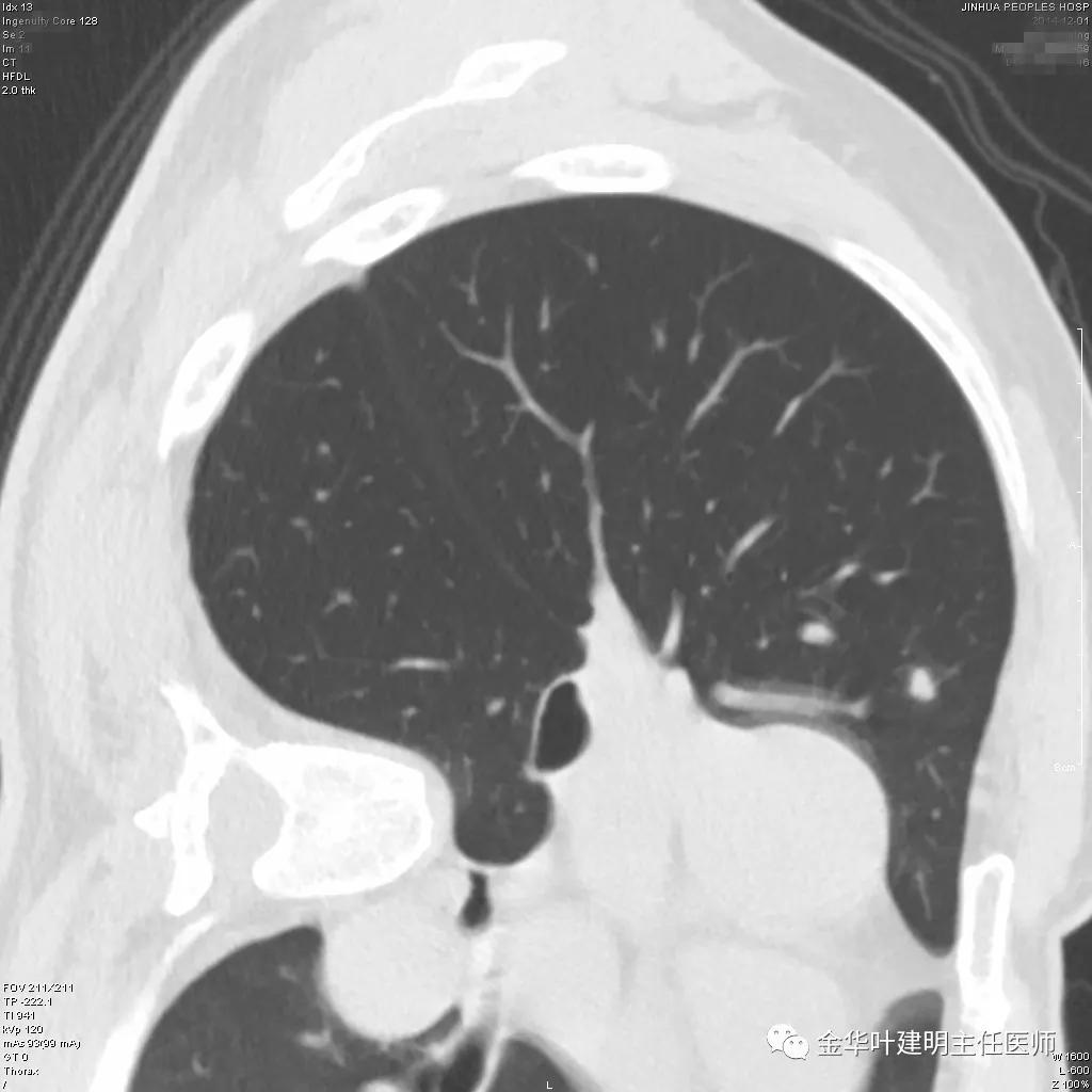 叶建明谈肺结节：一招分辨隐球菌性肉芽肿与肺癌
