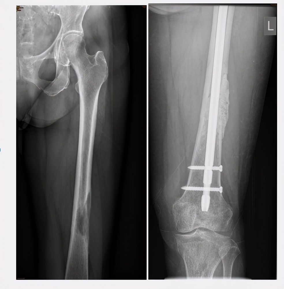 深入骨髓的痛！30年前不能治的骨转移，现在或有3个机会