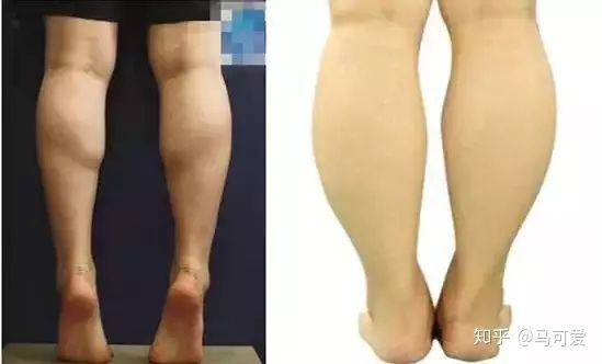 小腿粗怎么判断是脂肪还是肌肉,坐着快速瘦脂肪小腿的正确方法