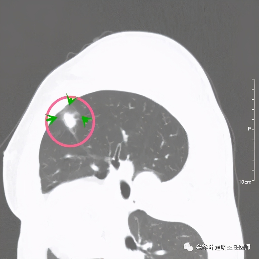 叶建明谈肺结节：一招分辨隐球菌性肉芽肿与肺癌