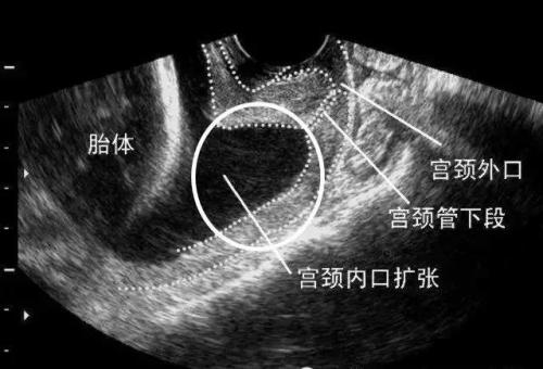 孕妈孕检必须做的,孕妈要做宫颈筛查