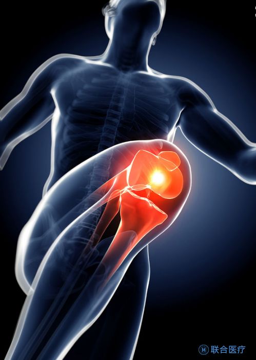 膝盖骨肿瘤的症状,少年膝盖结节里面痛