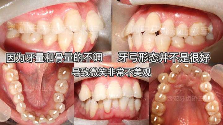 西安透明式牙齿矫正器龅牙,昆明牙齿矫正改变脸型