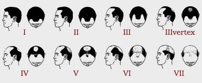 该怎么知道自己有没有脱发,不知道自己什么原因脱发