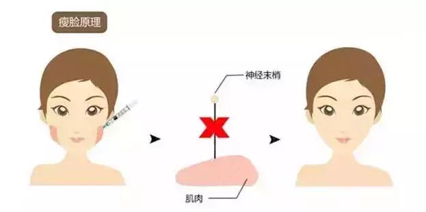 瘦脸针的5个常见问题,瘦脸针其实副作用挺大的