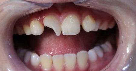 牙齿突然脱落是怎么回事,牙齿松动脱落是什么原因