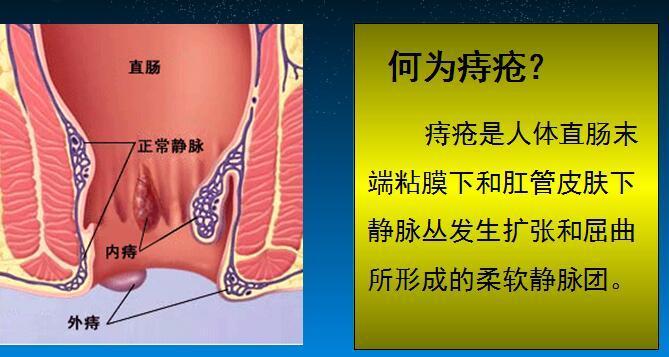 老年人频繁放屁大便变细是肠癌吗,大便变细怎么判断是肠癌还是痔疮