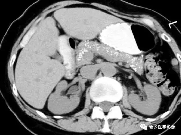 左肾可见高密度影不是结石,结节状高密度影是结石吗