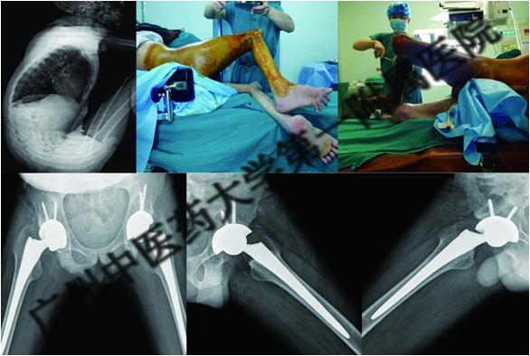 小伙子身患强直性脊柱炎自强不息,强直性脊柱炎康复后能干重活吗