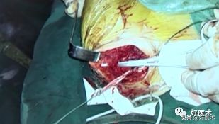 肩锁关节脱位手术后多久可以喝酒,肩锁关节脱位钢板内固定步骤记录