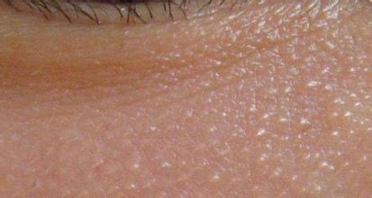 脂肪粒该如何消除,脂肪粒怎么办才能消除