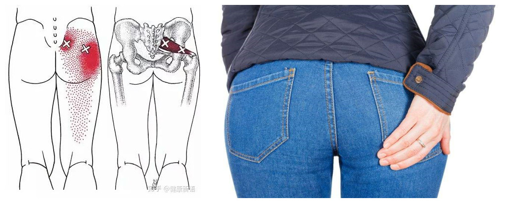 屁股痛、腿麻，有块肌肉受伤了