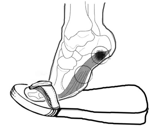 穿人字拖会影响腿型吗,穿人字拖对脚有伤害吗