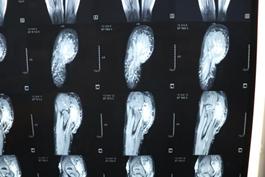 淋巴血管畸形治疗费用,淋巴静脉畸形治疗