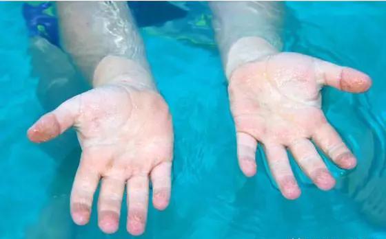 手指泡水后发白像烂了,手指泡水后出现大白泡