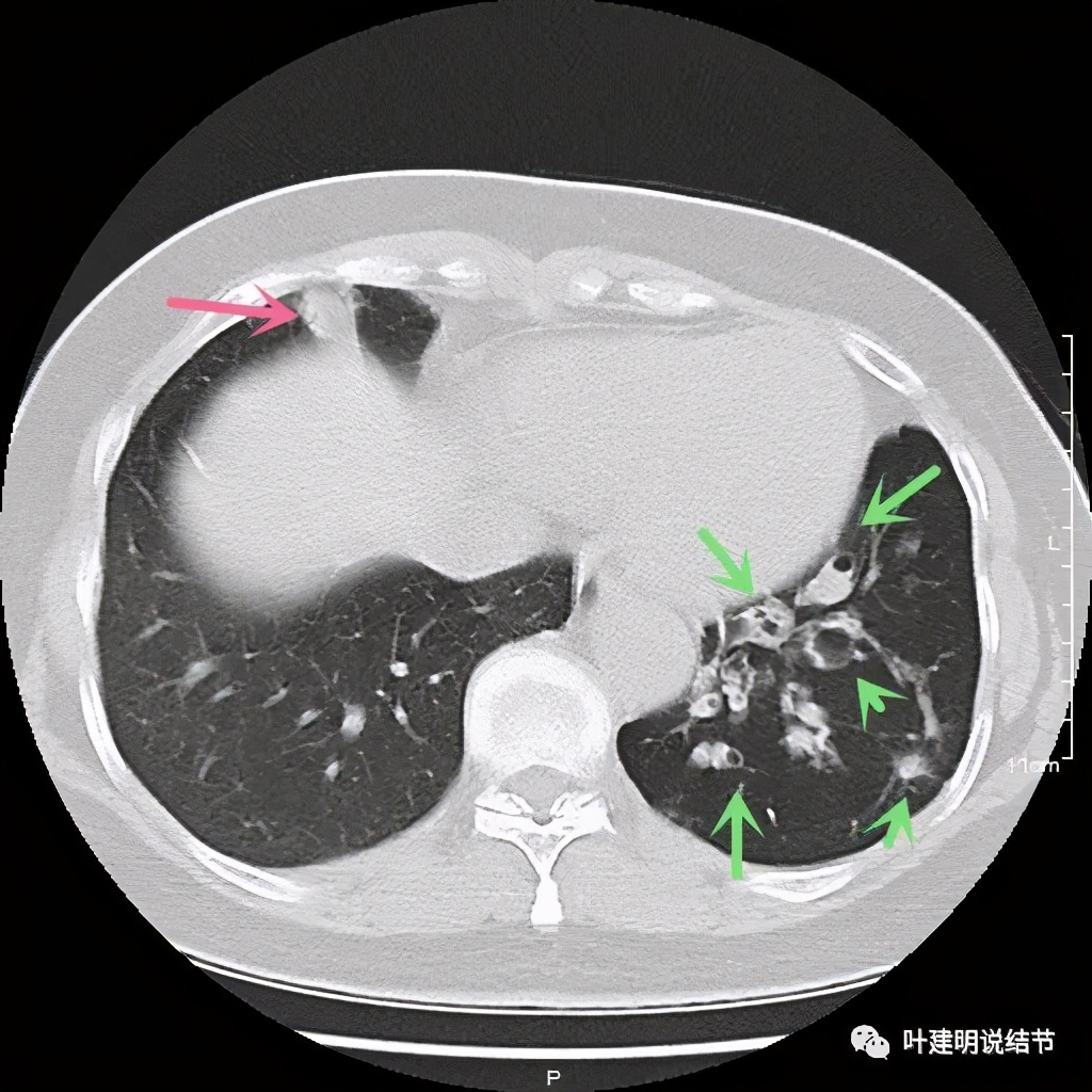 这样的实性结节伴小空洞会是肺癌吗？