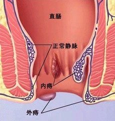 痔疮发炎肿痛怎么办,痔疮肿痛最佳的自愈方法