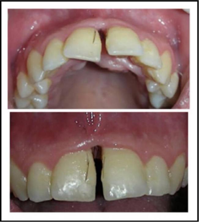一女子患上罕见牙龈多毛症，牙齿里竟然长出了毛发