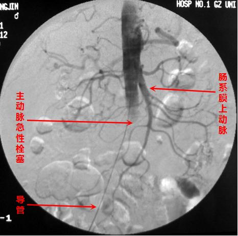 血管被堵怎么办？别怕！微创介入诊疗已有多种腔内开通手段！