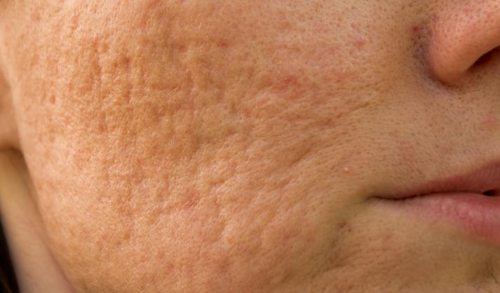 不想*疮痤**变月球表面，那这篇文章就是你需要的