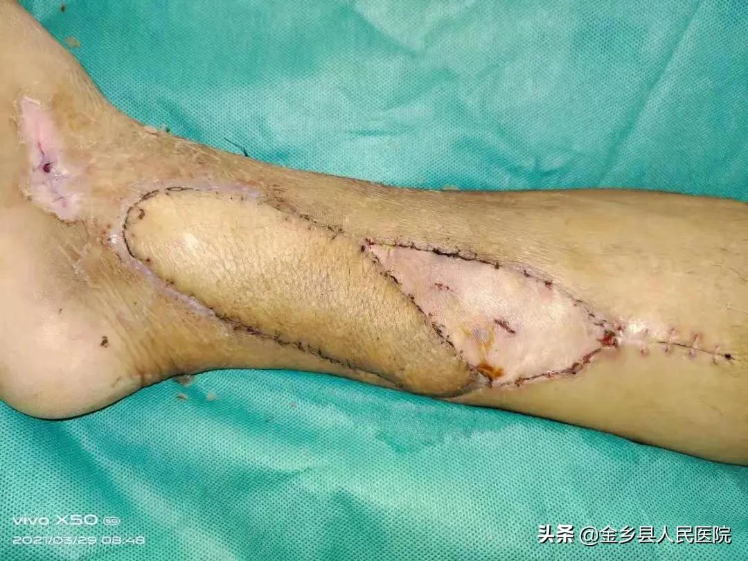 脚趾皮瓣手术失败后伤口能否愈合,手部软组织缺损做的游离皮瓣移植