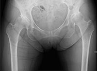 人工关节置换术适应症,关节置换术微创