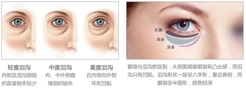 轻医美干细胞填充泪沟真实案例,泪沟明显怎么做医美