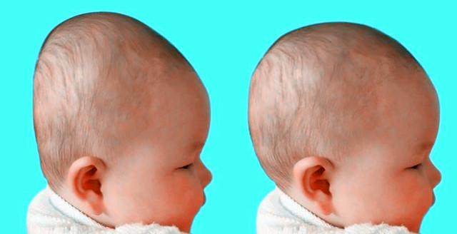 头型扁是睡的吗,头型是扁的