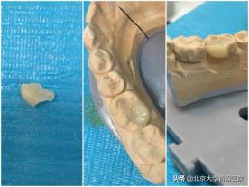 牙列缺损与牙体缺损,牙体缺失和牙列缺损区别