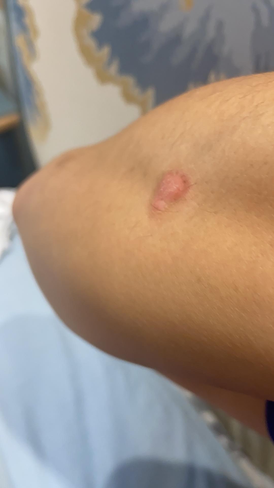 关于银屑病患者在冬季的关注事项,银屑病打生物制剂以后饮食要关注