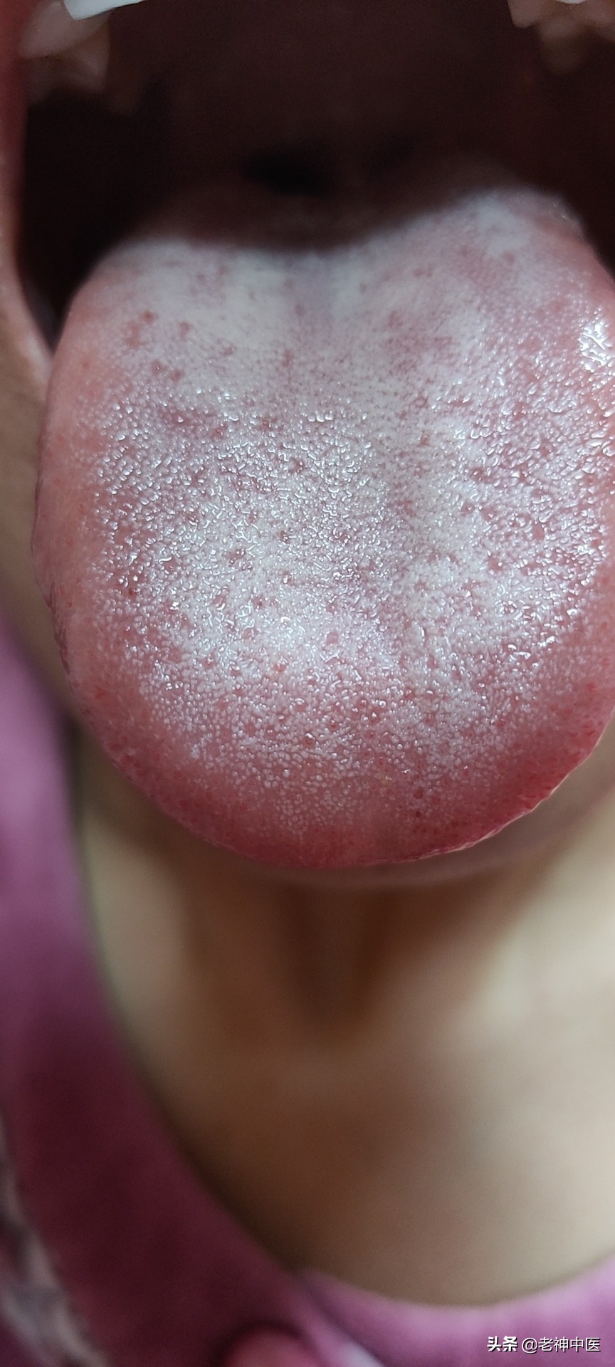 顽固性荨麻疹中医疗法,麻疹反反复复最快治疗方法