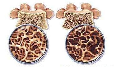 血钙含量和骨质疏松有关吗？
